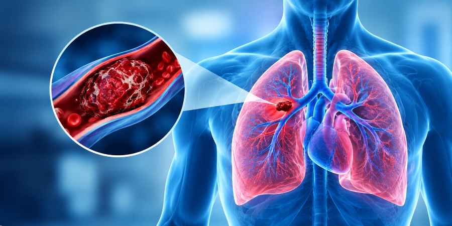 Blood Clots in the Lungs